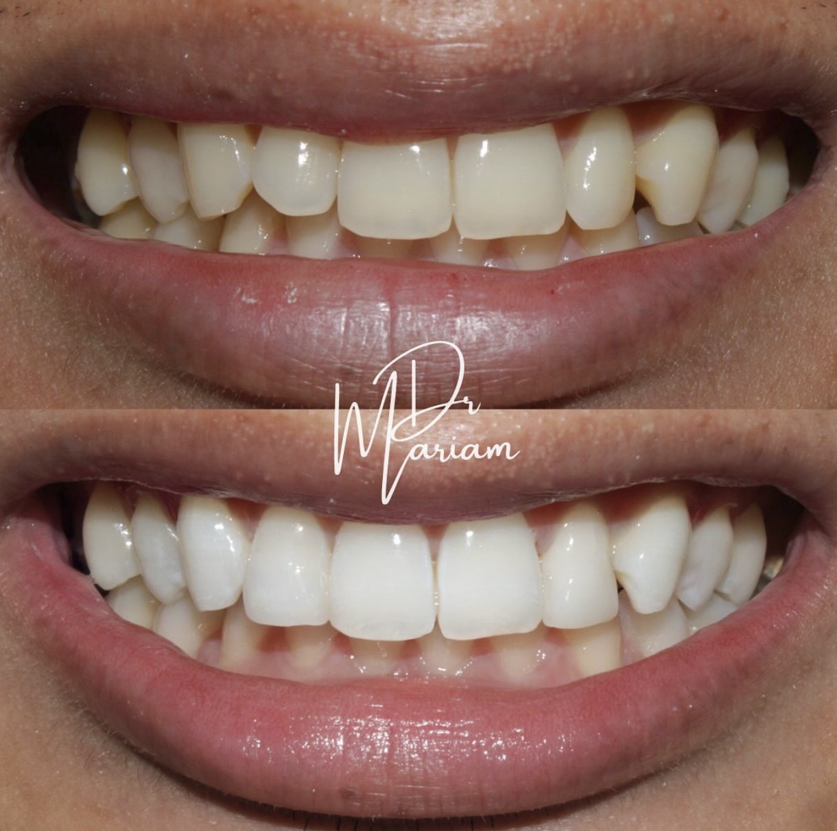 A smile before treatment with crowded, yellowed teeth, and after with brighter, evened teeth