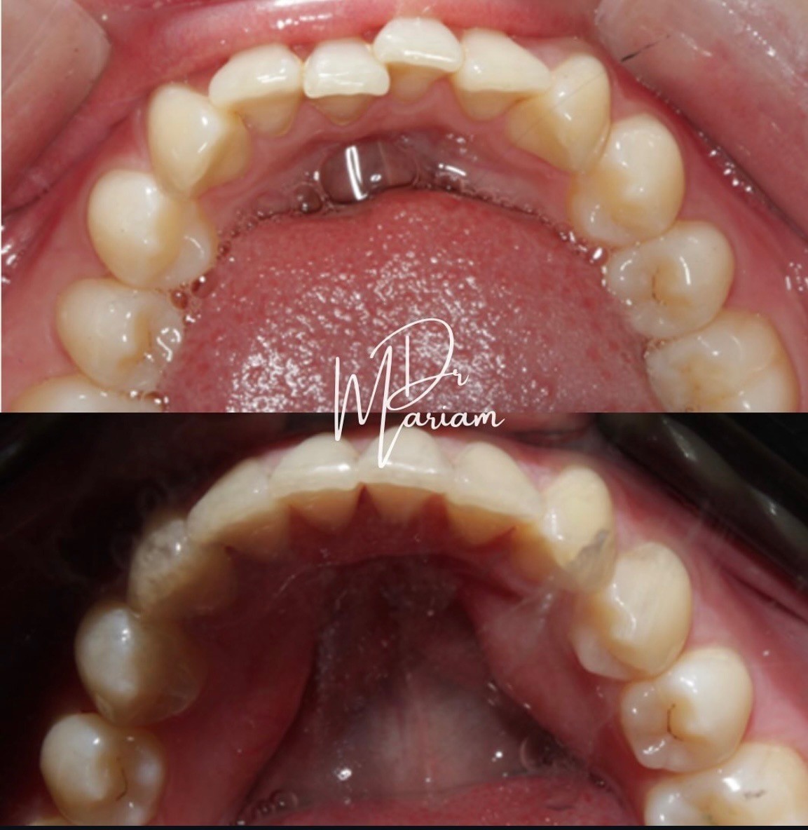 Lower teeth before treatment with crowding, and after with the teeth lined up