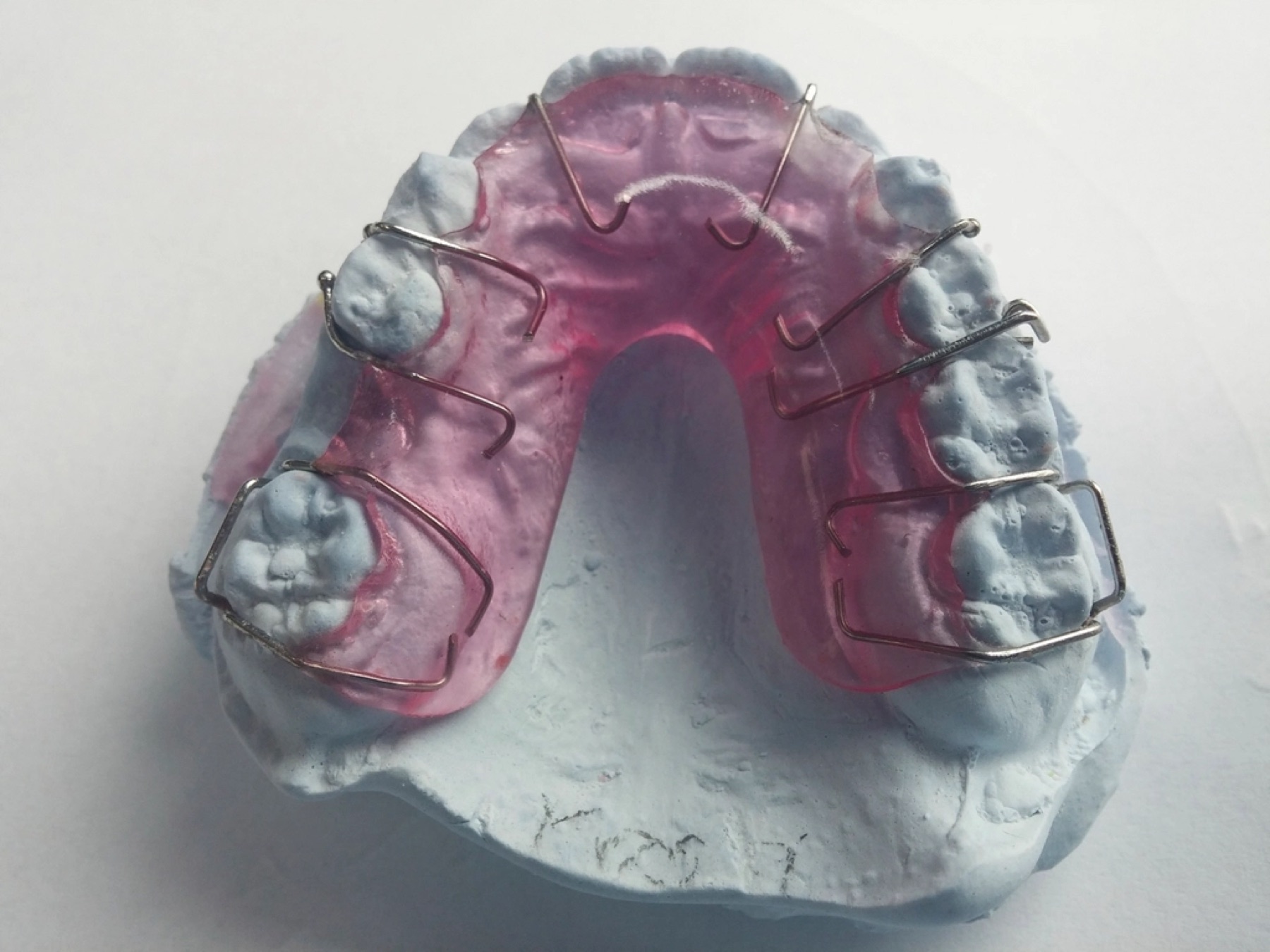 Orthodontic appliance on a dental model